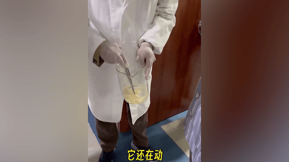 女子肛門處刺癢難忍，醫院用“南瓜籽+檳榔”驅蟲排出長達10米寄生蟲
