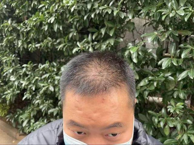 “還能反光！”長沙男子植發近9月稱后腦勺“像狗啃過”