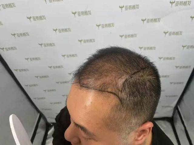 “還能反光！”長沙男子植發近9月稱后腦勺“像狗啃過”