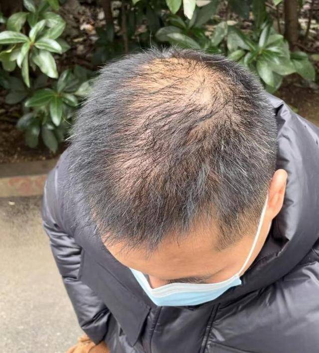 “還能反光！”長沙男子植發近9月稱后腦勺“像狗啃過”